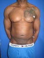 Vaser Liposuction