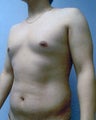 VASER Liposuction (HiDef)