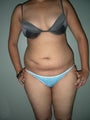 VASER Lipo - 25 yrs. old female (abdomen, back, flanks & thighs)