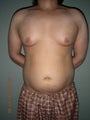 Vaser Liposuction