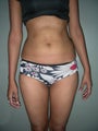 Vaser Liposuction