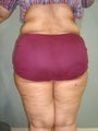 VASER lipo - Butt reduction