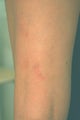 Laser Treatments for Spider Veins 