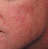 Vein Treatment