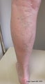 EVLT of Small Saphenous Vein