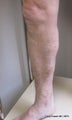 EVLT of right Greater Saphenous Vein