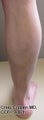 EVLT of Small Saphenous Vein