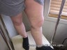 EVLT of Left Greater Saphenous Vein