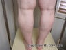 EVLT of Small Saphenous Vein