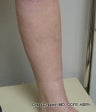 EVLT of Left Greater Saphenous Vein