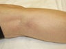 Leg Vein Removal