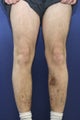 vnus ablation