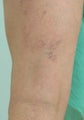 Laser Treatments for Spider Veins 
