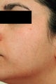 Facial Spider Vein Removal 