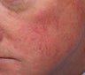 Vein Treatment