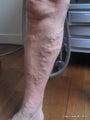 EVLT of right Greater Saphenous Vein