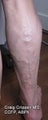 EVLT of Small Saphenous Vein