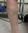 EVLT of Left Greater Saphenous Vein