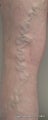 Ambulatory Phlebectomy