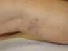 Leg Vein Removal