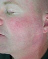 Facial Vein Treatment