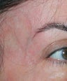 Laser Vein Removal 