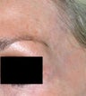 Laser facial vein treatment