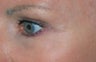 Facial vein removal