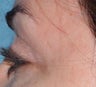 Laser Vein Removal