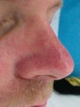 Laser Vein Treatment 
