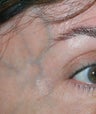 Laser Vein Removal 