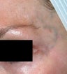 Laser facial vein treatment