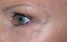 Facial vein removal