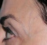 Laser Vein Removal