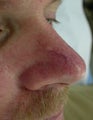 Laser Vein Treatment 