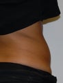Cool Sculpting