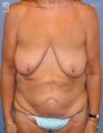 Major Weight Loss Surgery
