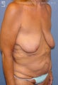 Major Weight Loss Surgery