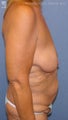 Major Weight Loss Surgery