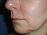 Wrinkle Treatment