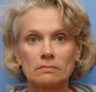 Liquid Facelift for Nasolabial Folds
