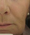 Radiesse for Nasolabial Folds and Marionette Lines