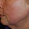 Total FX CO2 Laser