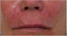 Juvederm to nasolabial folds