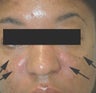 Treatment for Laugh lines