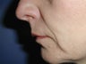 Wrinkle Treatment