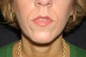 Wrinkle Treatment