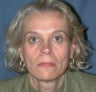 Liquid Facelift for Nasolabial Folds