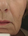 Radiesse for Nasolabial Folds and Marionette Lines