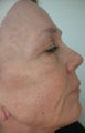 Wrinkle Removal